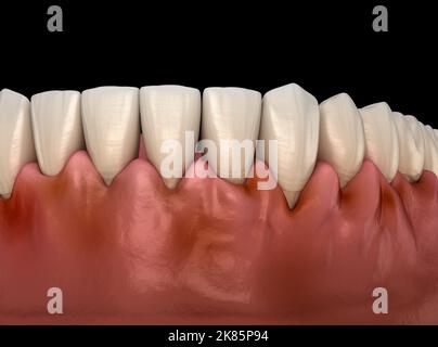 Gingivite inflammation des gencives. Illustration 3D médicale précise Banque D'Images