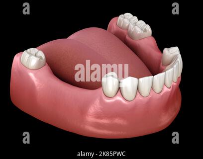 Prothèse mandibulaire, prothèse partielle amovible. 3D illustration médicale précise du concept de la prosthodontie Banque D'Images