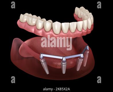 Prothèse mandibulaire amovible avec gomme sur le système 4 supporté par des implants. 3D illustration médicale précise des dents et des prothèses dentaires humaines Banque D'Images