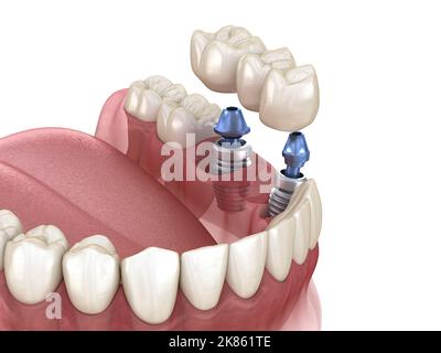 Bridge dentaire en charge par implants. Illustration 3D précis sur des dents humaines et de prothèses dentaires concept Banque D'Images
