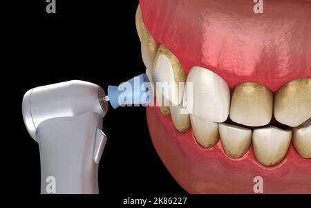 Procédure de polissage des dents avec brosse professionnelle et gel. Illustration 3D précis médicalement Banque D'Images