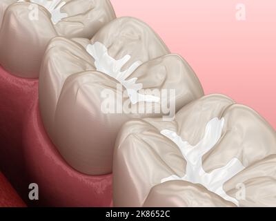 Plombages dentaires molaires fissure, médicalement précis 3D illustration du concept dentaire Banque D'Images