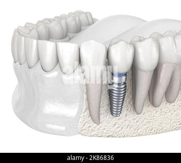 Dent prémolaire récupération avec implant. Illustration 3D précis sur des dents humaines et de prothèses dentaires concept Banque D'Images