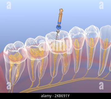 Processus de traitement des canaux racinaires endodontiques. Illustration de la dent 3D médicalement précise. Banque D'Images