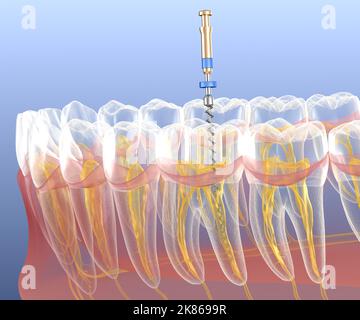 Processus de traitement des canaux racinaires endodontiques. Illustration de la dent 3D médicalement précise. Banque D'Images