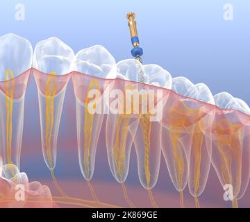 Processus de traitement des canaux racinaires endodontiques. Illustration de la dent 3D médicalement précise. Banque D'Images