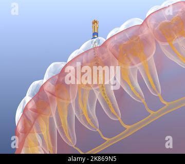 Processus de traitement des canaux racinaires endodontiques. Illustration de la dent 3D médicalement précise. Banque D'Images