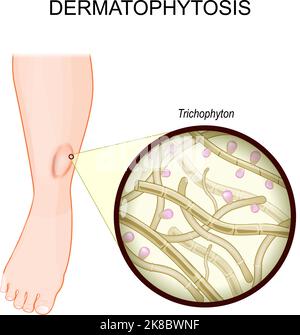 Dermatophytose. Teigne sur une jambe humaine. Infection fongique de la peau. Gros plan d'un Trichophyton. Les champignons qui ont causé la maladie de la teigne. Vecteur Illustration de Vecteur