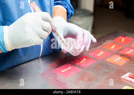 Les échantillons de biopsie traités au laboratoire de pathologie doivent être inclus dans la paraffine pour analyse. Concept de diagnostic de cancer. Concept médical. Banque D'Images