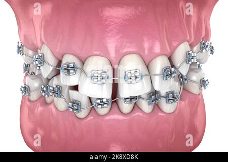 Position et correction des dents anormales avec un tréteau métallique. Illustration dentaire 3D précise sur le plan médical Banque D'Images