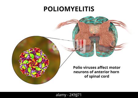 Les virus de la polio affectant les motoneurones, illustration Banque D'Images