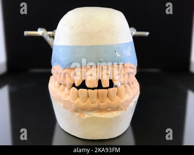 Modèle de plâtre dentaire pliant dans l'occlure de la mâchoire supérieure et inférieure d'une personne pour la fabrication de couronnes en céramique. Laboratoire dentaire Banque D'Images