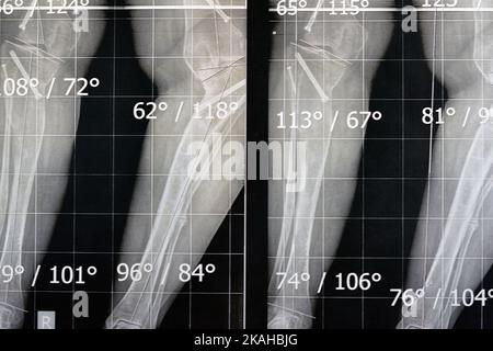 Position debout du long film à rayons X simple montrant les deux jambes avec le genu varum métaphysaire bilatéral, l'épiphysiodésie antérieure, le fémur distal gauche valgus et Banque D'Images