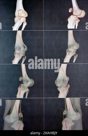 Angiographie CT du genou gauche 3D vue montrant l'artère poplitée patente et ses bifurcations artères tibiales et péroniques sur un patient avec bilatérale Banque D'Images