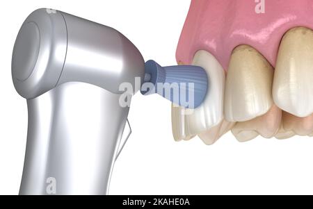 Procédure de polissage des dents avec brosse professionnelle et gel. Illustration 3D précis médicalement Banque D'Images