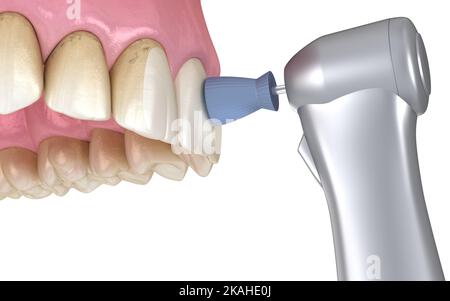 Procédure de polissage des dents avec brosse professionnelle et gel. Illustration 3D précis médicalement Banque D'Images
