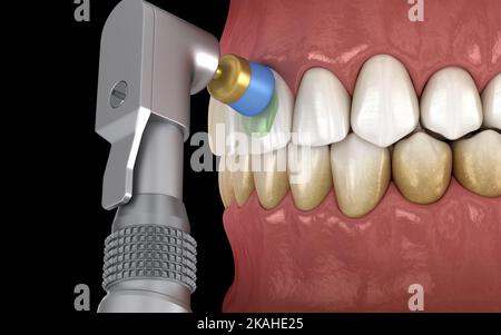 Procédure de polissage des dents avec brosse professionnelle et gel. Illustration 3D précis médicalement Banque D'Images