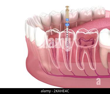 Processus de traitement des canaux racinaires endodontiques. Illustration de la dent 3D médicalement précise. Banque D'Images