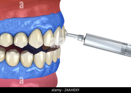 Blanchiment professionnel des dents. Ajout de gel sur les dents. 3D concept d'illustration. Banque D'Images