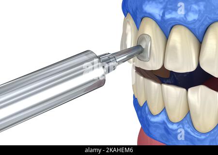 Blanchiment professionnel des dents. Ajout de gel sur les dents. 3D concept d'illustration. Banque D'Images