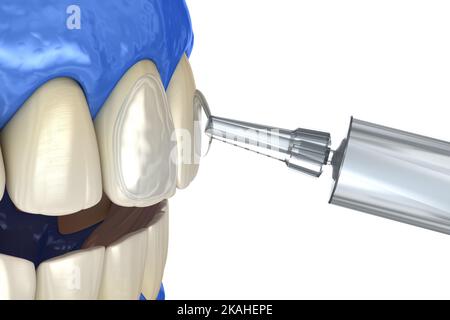 Blanchiment professionnel des dents. Ajout de gel sur les dents. 3D concept d'illustration. Banque D'Images