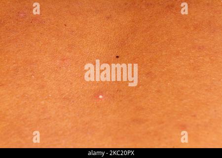 texture de la peau humaine. boutons sur la peau micro photo. gros plan photo. Banque D'Images