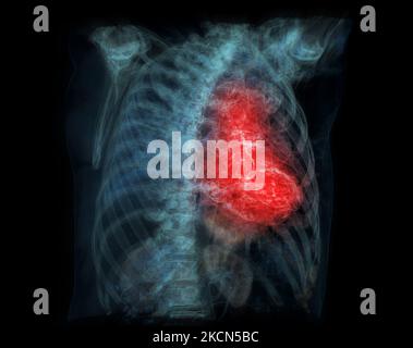 Les droits de l'attaque cardiaque de la douleur comme une anatomie maladie médicale concept avec une personne souffrant d'une maladie cardiaque comme un douloureux événement coronarien avec illus 3D Banque D'Images