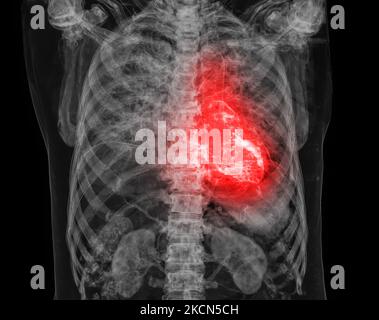 Les droits de l'attaque cardiaque de la douleur comme une anatomie maladie médicale concept avec une personne souffrant d'une maladie cardiaque comme un douloureux événement coronarien avec illus 3D Banque D'Images