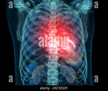 Les droits de l'attaque cardiaque de la douleur comme une anatomie maladie médicale concept avec une personne souffrant d'une maladie cardiaque comme un douloureux événement coronarien avec illus 3D Banque D'Images