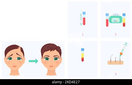 Traitement de perte de cheveux PRP, illustration conceptuelle Banque D'Images