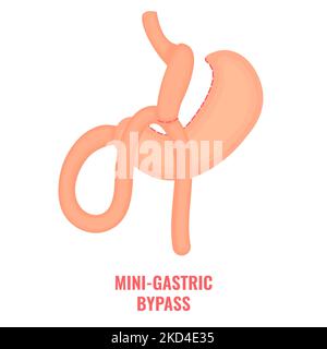 Mini chirurgie bariatrique de dérivation gastrique, illustration Banque D'Images