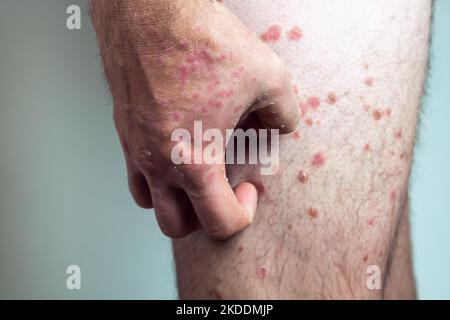 Homme méconnaissable souffrant de psoriasis, rayant des amas squameux épais, éruption cutanée enflammée sur la peau de la jambe avec les doigts affectés sur fond blanc. Banque D'Images