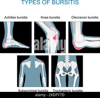 Types de bursite. Inflammation des sacs avec le liquide synovial. Définir les icônes des articulations du genou, de l'Achille, de la hanche, du coude et de l'épaule. Vecteur plat monochrome Illustration de Vecteur