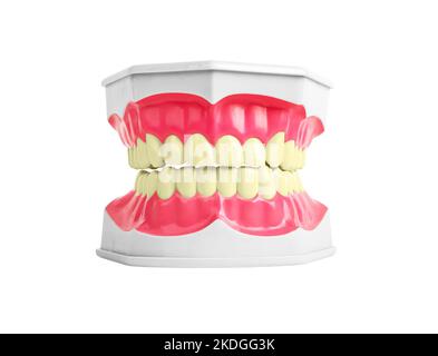 Mauvaises dents malsaines de couleur jaune avec caries maladie dentaire. Modèle à mâchoire avec mauvais émail. Photo de haute qualité Banque D'Images