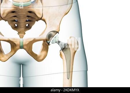 Prothèse de hanche ou implant isolé sur fond blanc avec espace de copie et contours du corps. Remplacement de l'articulation de la hanche ou de la tête fémorale 3D illustrat de rendu Banque D'Images