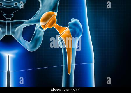 Illustration du rendu de la prothèse de hanche à rayons X 3D. Arthroplastie totale de la hanche, chirurgie de remplacement ou arthroplastie, médecine et soins de santé, arthrite, pathologie, science-fiction Banque D'Images