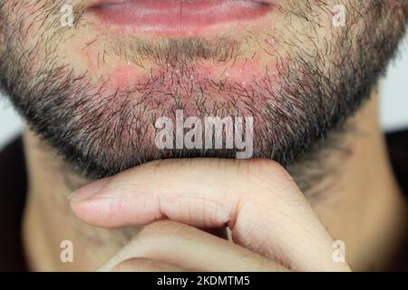 Dermatite séborrhéique dans la barbe. Eczéma sur le visage masculin gros plan. Banque D'Images