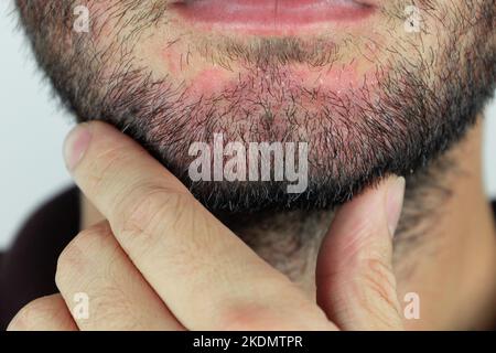 Dermatite séborrhéique dans la barbe. Eczéma sur le visage masculin gros plan. Banque D'Images