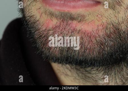 Dermatite séborrhéique dans la barbe. Eczéma sur le visage masculin gros plan. Banque D'Images