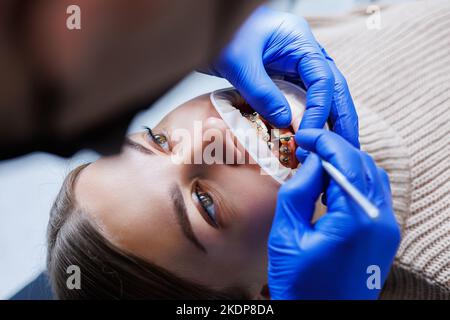 Les dents d'une femme avec des bretelles métalliques sont traitées à la clinique. Un orthodontiste utilise des instruments dentaires pour placer des bretelles sur les dents d'un patient. Sélection Banque D'Images