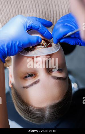 Les dents d'une femme avec des bretelles métalliques sont traitées à la clinique. Un orthodontiste utilise des instruments dentaires pour placer des bretelles sur les dents d'un patient. Sélection Banque D'Images