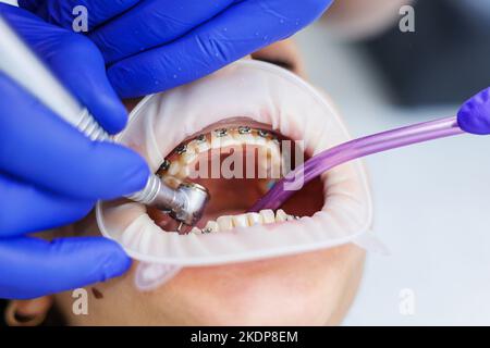 Les dents d'une femme avec des bretelles métalliques sont traitées à la clinique. Un orthodontiste utilise des instruments dentaires pour placer des bretelles sur les dents d'un patient. Sélection Banque D'Images