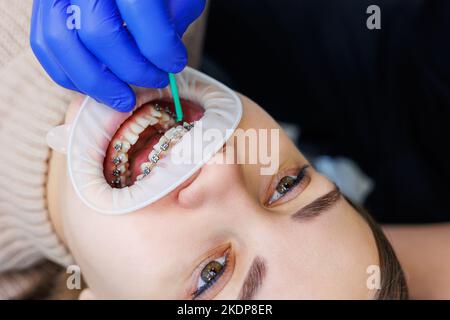 Les dents d'une femme avec des bretelles métalliques sont traitées à la clinique. Un orthodontiste utilise des instruments dentaires pour placer des bretelles sur les dents d'un patient. Sélection Banque D'Images