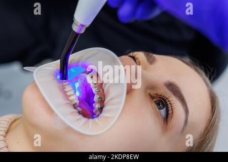 Les dents d'une femme avec des bretelles métalliques sont traitées à la clinique. Un orthodontiste utilise des instruments dentaires pour placer des bretelles sur les dents d'un patient. Sélection Banque D'Images