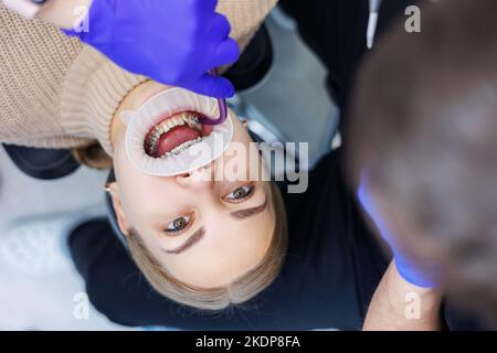 Les dents d'une femme avec des bretelles métalliques sont traitées à la clinique. Un orthodontiste utilise des instruments dentaires pour placer des bretelles sur les dents d'un patient. Sélection Banque D'Images