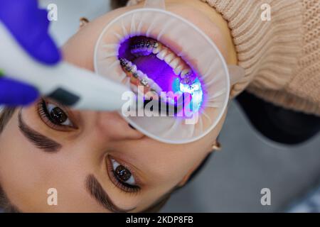 Les dents d'une femme avec des bretelles métalliques sont traitées à la clinique. Un orthodontiste utilise des instruments dentaires pour placer des bretelles sur les dents d'un patient. Sélection Banque D'Images