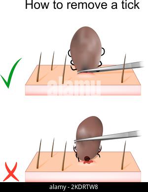 Comment retirer une tique. Élimination des acariens. Illustration vectorielle Illustration de Vecteur