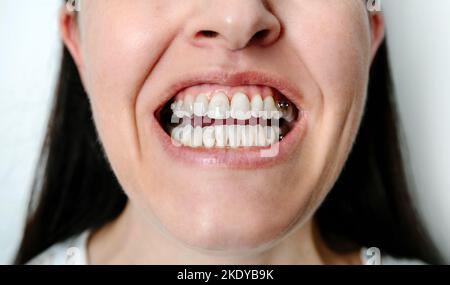 Femme à bouche ouverte montrant des accessoires et des boutons dentaires pour le traitement orthodontique Banque D'Images