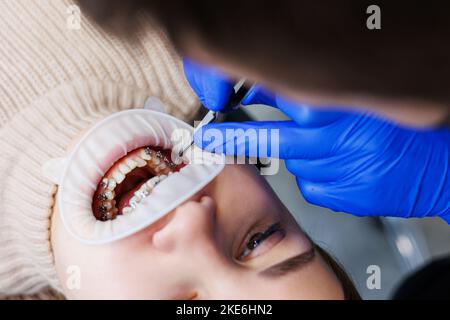 Les dents d'une femme avec des bretelles métalliques sont traitées à la clinique. Un orthodontiste utilise des instruments dentaires pour placer des bretelles sur les dents d'un patient. Sélection Banque D'Images