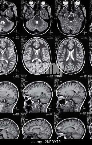 Acquisition d'images par résonance magnétique à haute résolution du syndrome d'epi cérébral. Véritable IRM de la tête, gros plan. Banque D'Images